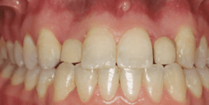 Patient 2 – Before