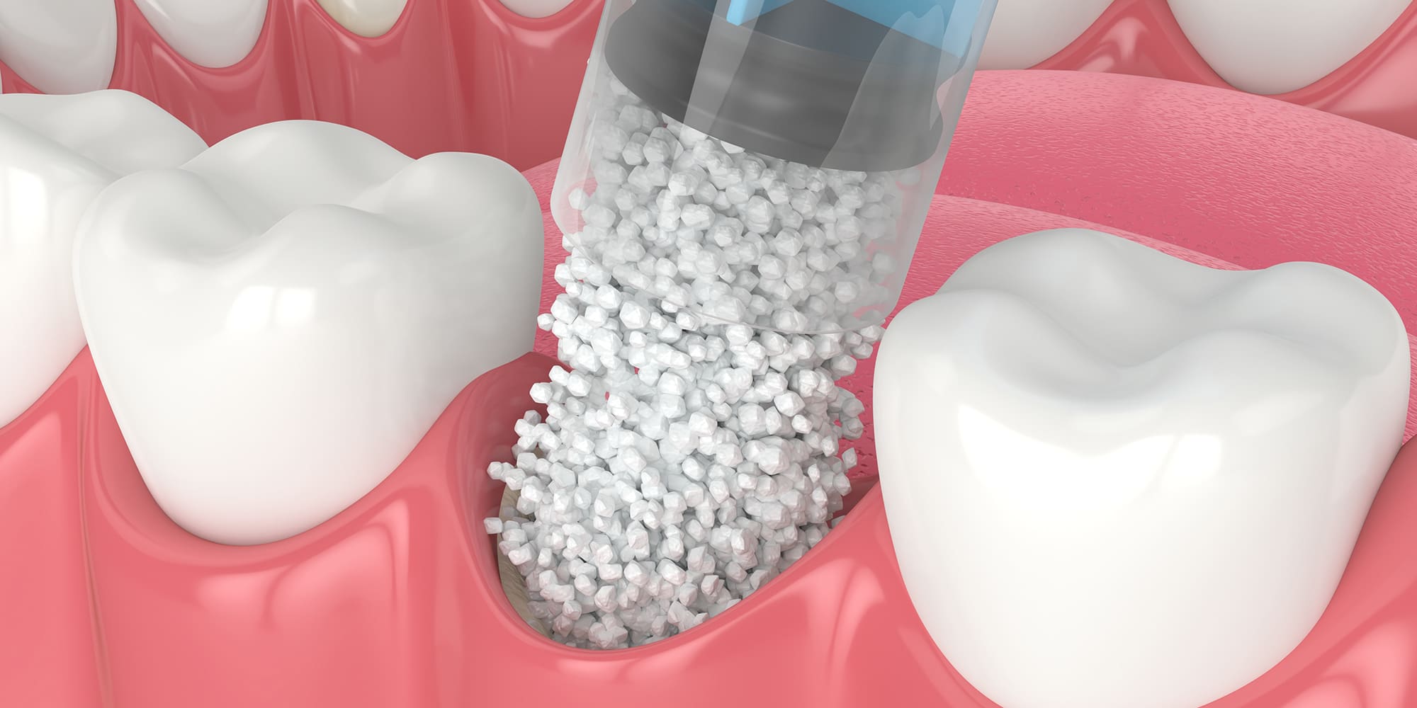 Dental Bone Grafting Procedure