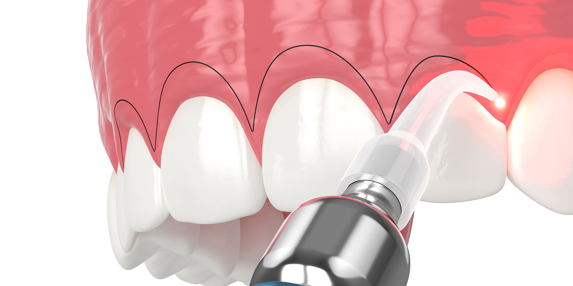 Gummy Smile Treatment