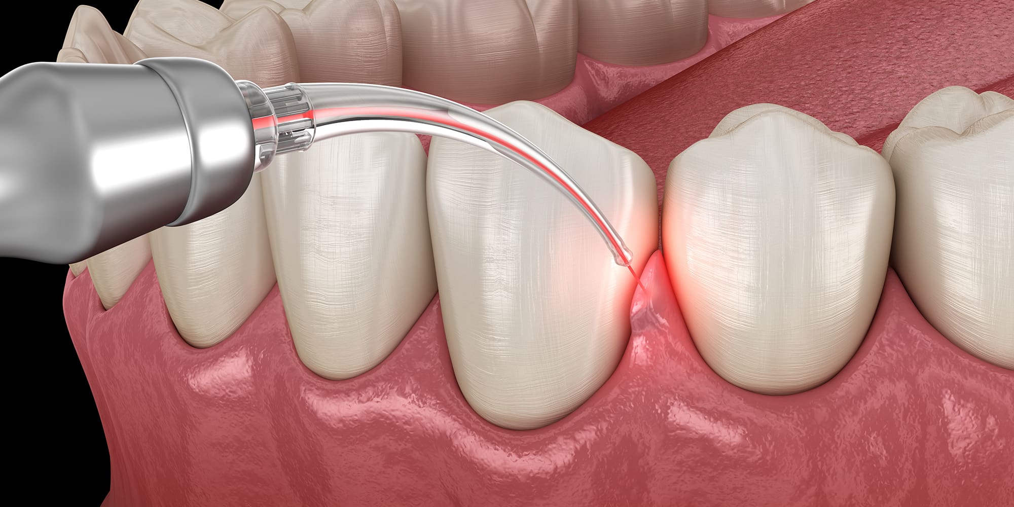 Laser Periodontal Therapy