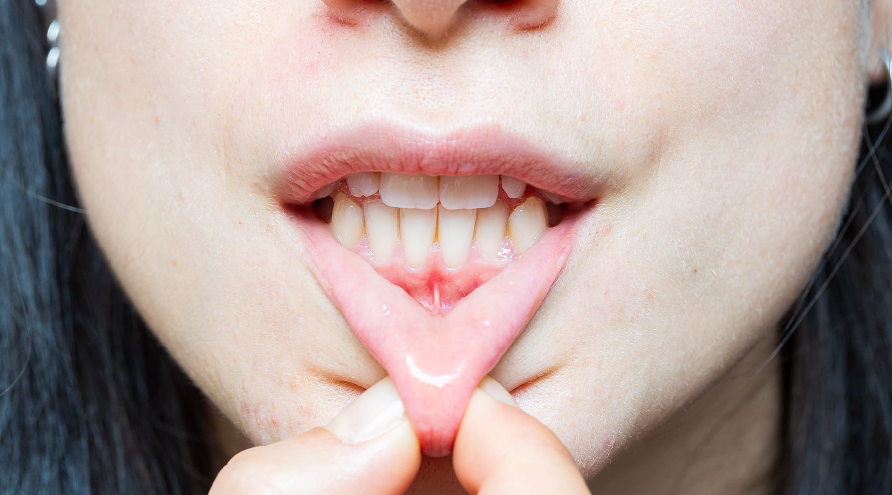 What Causes Gum Recession and How It Is Treated