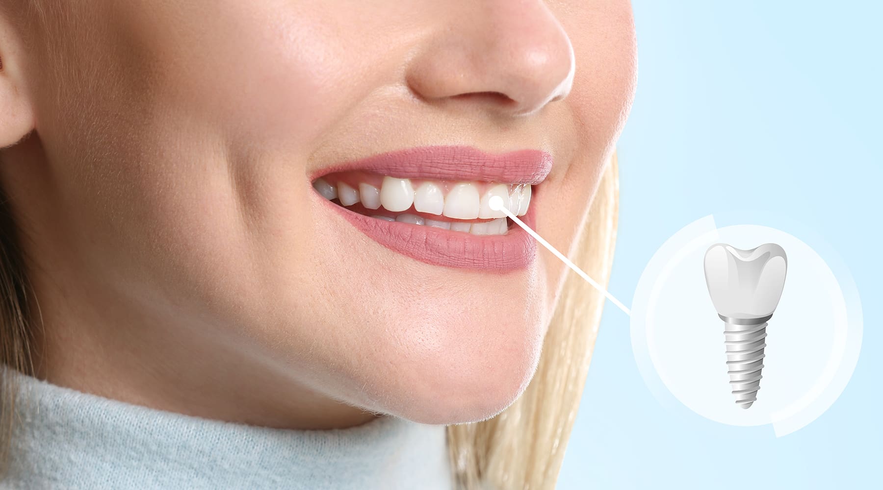 What Are the Parts of a Dental Implant?