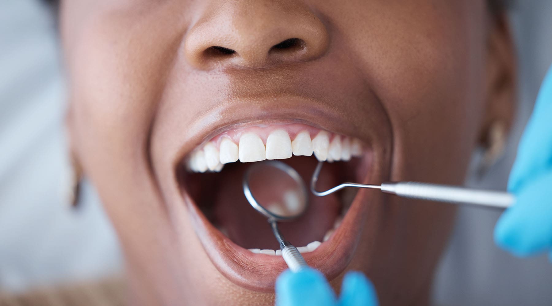 Why Gum Disease Often Goes Undiagnosed