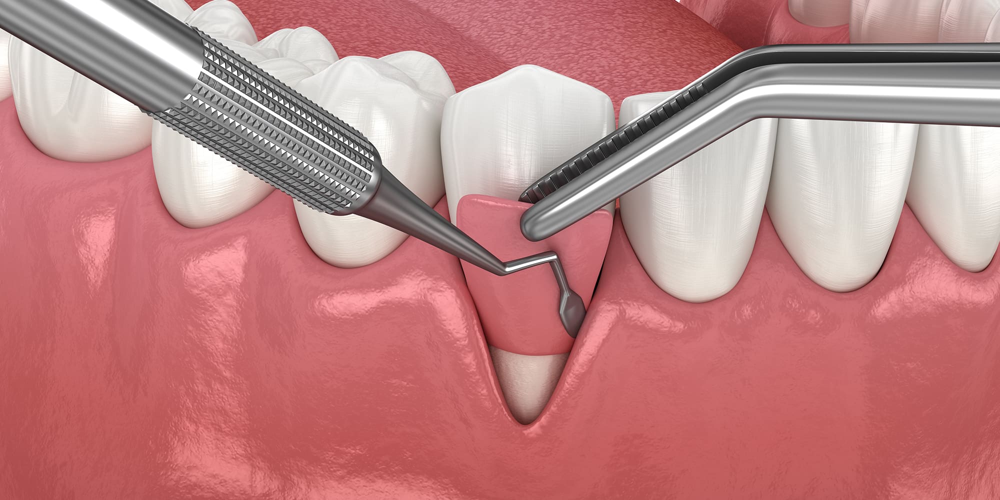 Pinhole Surgical Technique